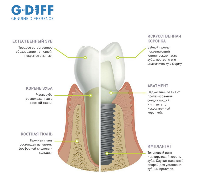 Дентальная имплантация 1